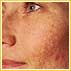 Melasma Is Common In Pregnancy